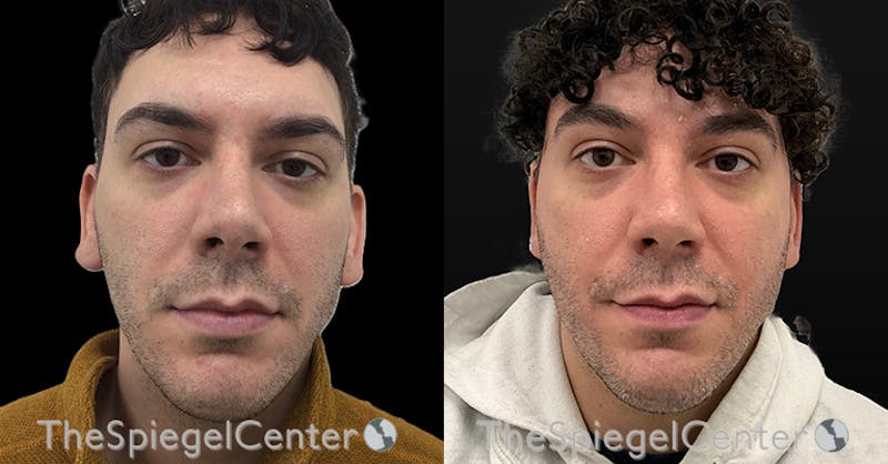 Ear Pinning / Otoplasty Before & After Gallery - Patient 399413 - Image 1