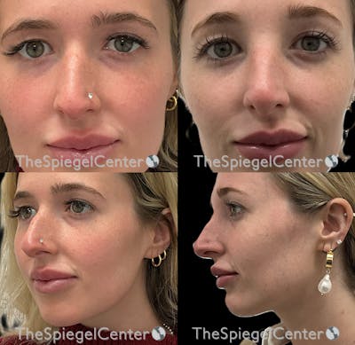 Non-Surgical Rhinoplasty / Nose Filler Before & After Gallery - Patient 333839 - Image 1