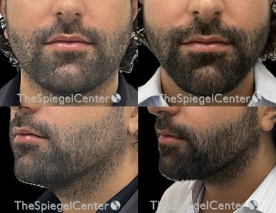 Mandible Jaw Filler Before & After Gallery - Patient 109528 - Image 1