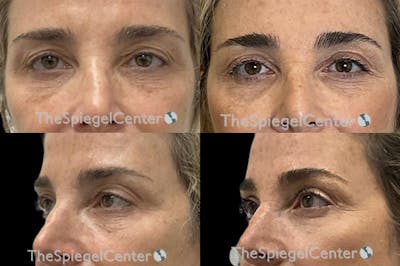 Blepharoplasty Before & After Gallery - Patient 395078 - Image 1