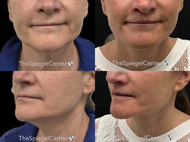 Facelift Before & After Gallery - Patient 353754 - Image 1