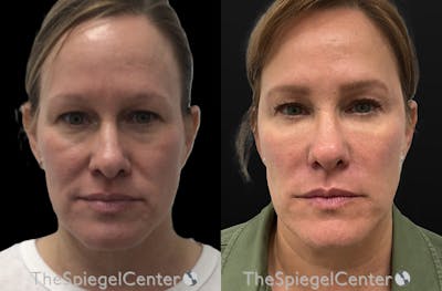 Liquid Face Lift Before & After Gallery - Patient 285393 - Image 1