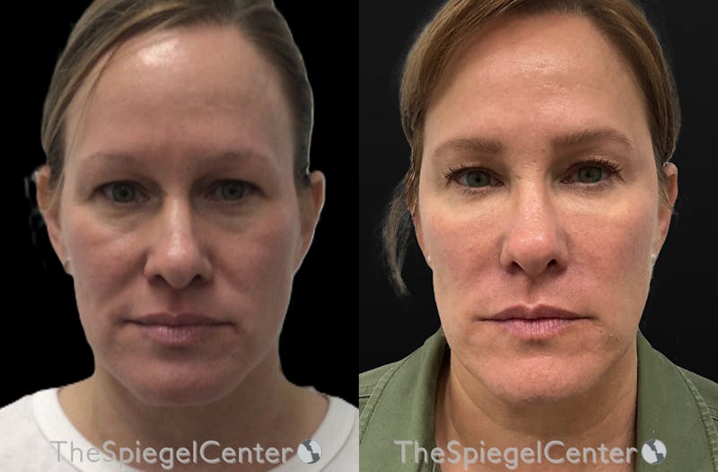 Liquid Face Lift Before & After Gallery - Patient 285393 - Image 1