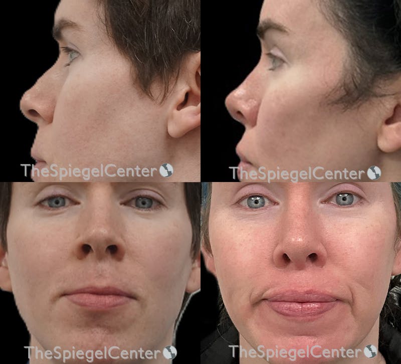 Cheek Implants Before & After Gallery - Patient 326746 - Image 1