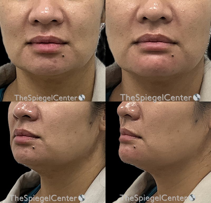 Chin Filler Before & After Gallery - Patient 268934 - Image 1