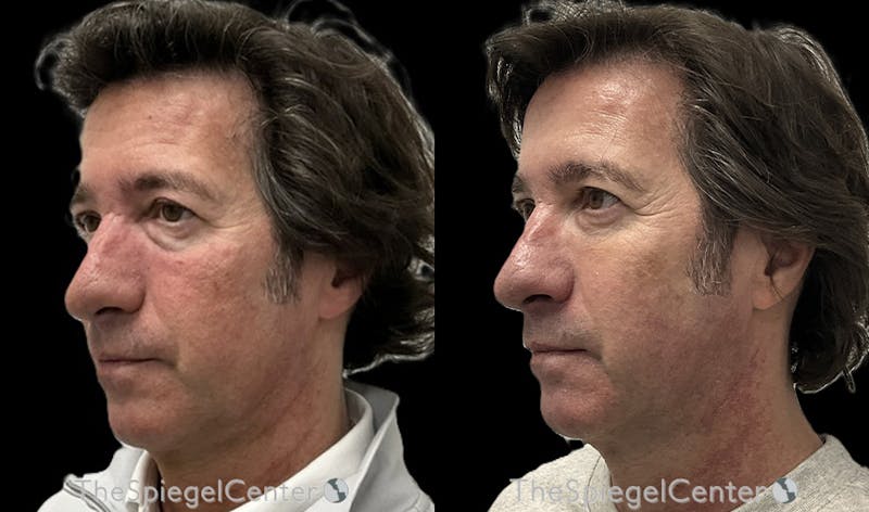 IPL / Intense Pulse Light Before & After Gallery - Patient 360540 - Image 1
