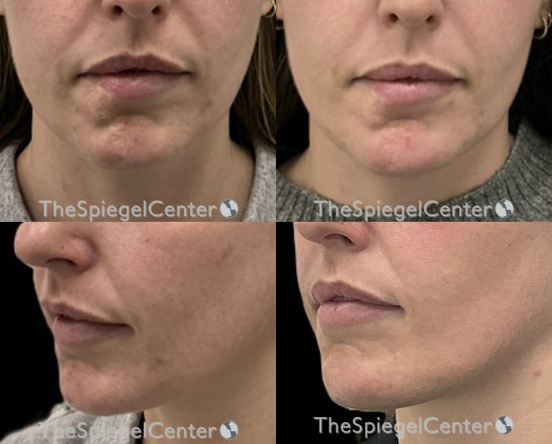 Chin Filler Before & After Gallery - Patient 338912 - Image 1