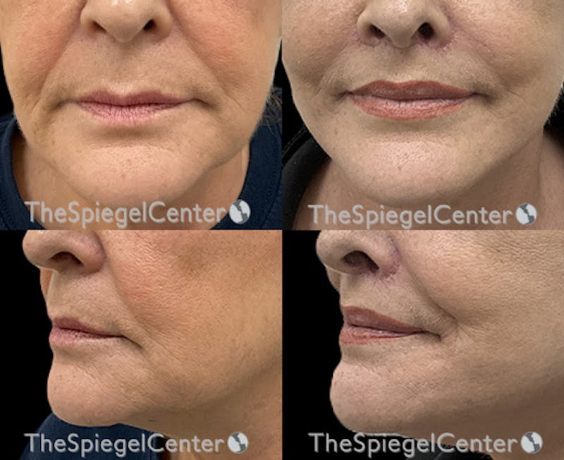 Lip Lift Before & After Gallery - Patient 302135 - Image 1