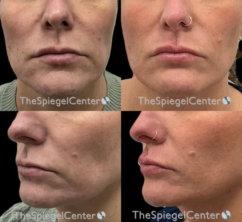 Nasolabial Fold Filler Before & After Gallery - Patient 414344 - Image 1