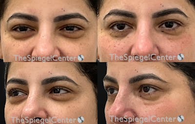 Tear Trough / Under Eye Fillers Before & After Gallery - Patient 156466 - Image 1