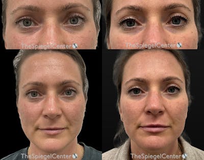 Temple Filler Before & After Gallery - Patient 278682 - Image 1