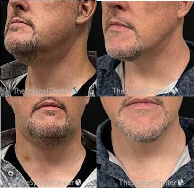 Neck Lift Before & After Gallery - Patient 236880 - Image 1