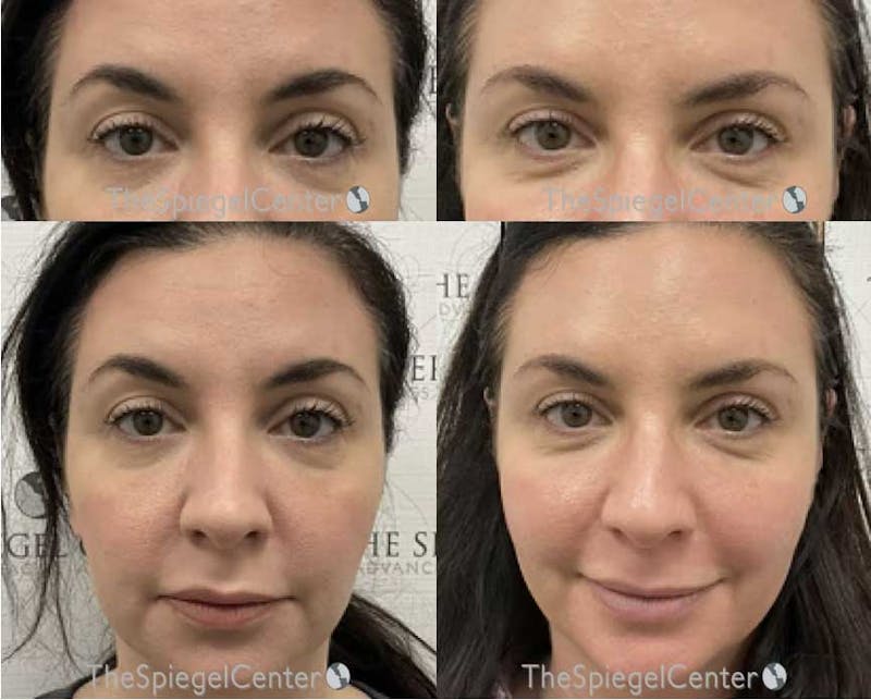 Temple Filler Before & After Gallery - Patient 124343 - Image 1