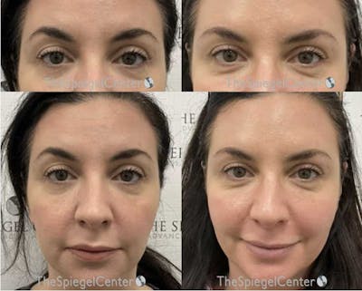 Temple Filler Before & After Gallery - Patient 124343 - Image 1