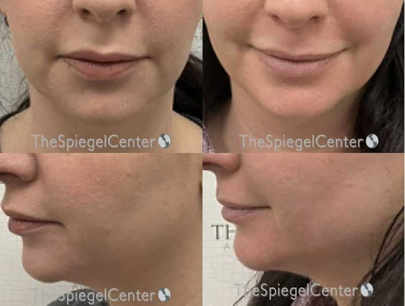Chin Filler Before & After Gallery - Patient 422394 - Image 1