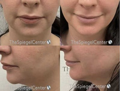 Chin Filler Before & After Gallery - Patient 422394 - Image 1