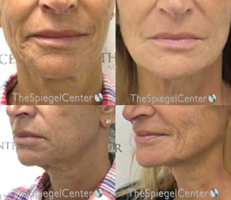 Chin Filler Before & After Gallery - Patient 936847 - Image 1