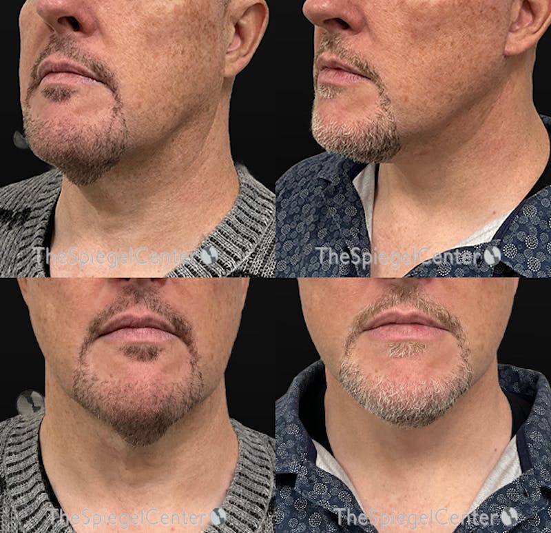 Neck Lift Before & After Gallery - Patient 126191 - Image 1