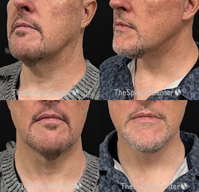 Neck Lift Before & After Gallery - Patient 126191 - Image 1