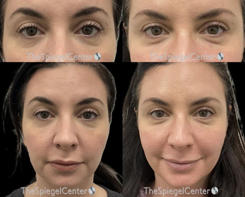 Temple Filler Before & After Gallery - Patient 209946 - Image 1