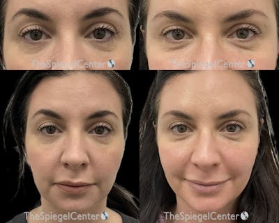 Temple Filler Before & After Gallery - Patient 209946 - Image 1