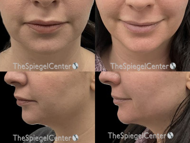 Chin Filler Before & After Gallery - Patient 263981 - Image 1