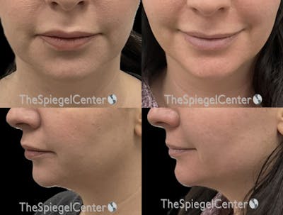 Chin Filler Before & After Gallery - Patient 263981 - Image 1
