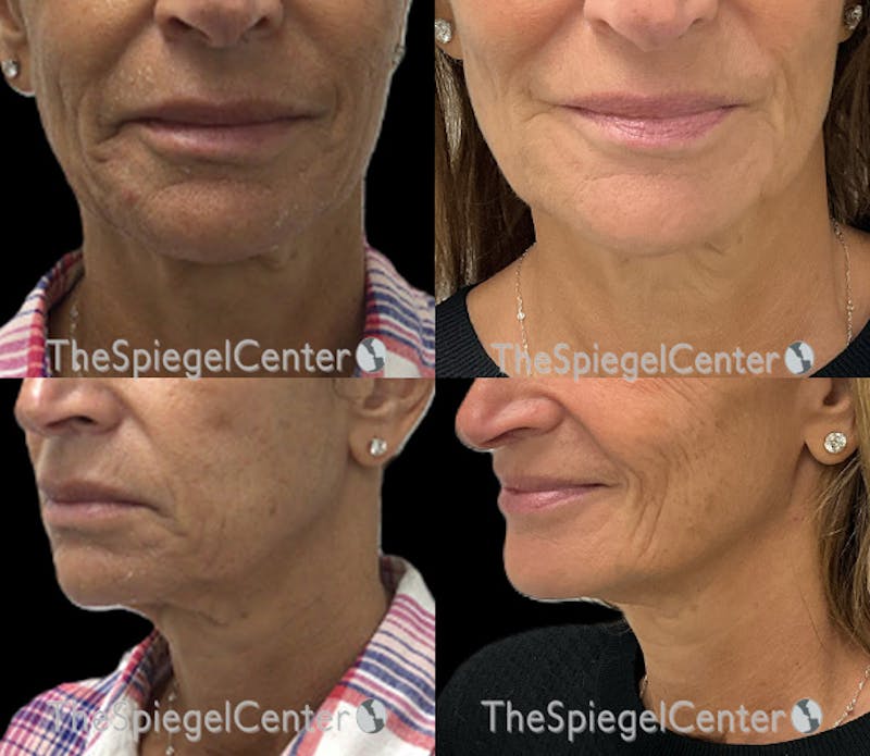 Chin Filler Before & After Gallery - Patient 626045 - Image 1