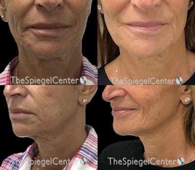 Chin Filler Before & After Gallery - Patient 626045 - Image 1