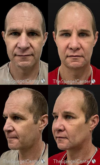 FFS Before & After Gallery - Patient 210704 - Image 1