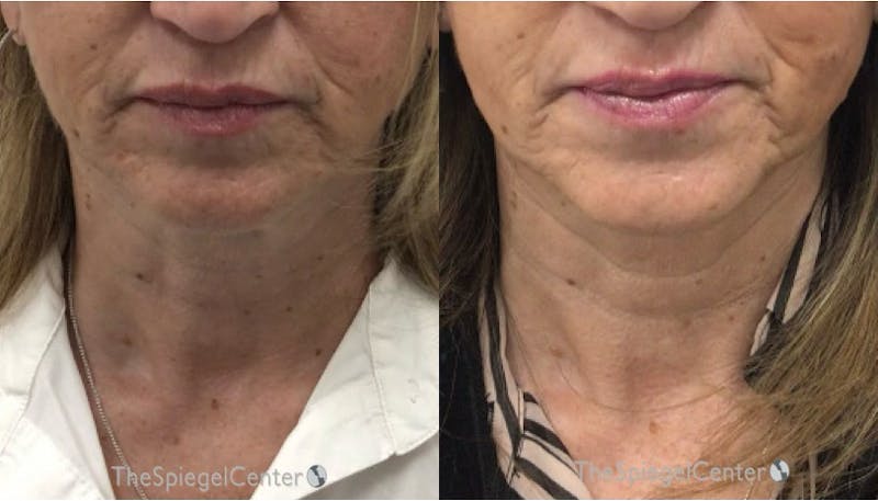 Neck Botox Before & After Gallery - Patient 185862 - Image 1