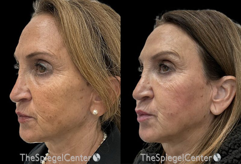 IPL / Intense Pulse Light Before & After Gallery - Patient 288733 - Image 1