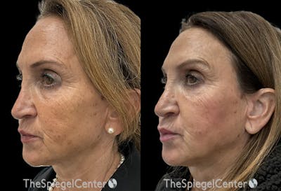 IPL / Intense Pulse Light Before & After Gallery - Patient 288733 - Image 1
