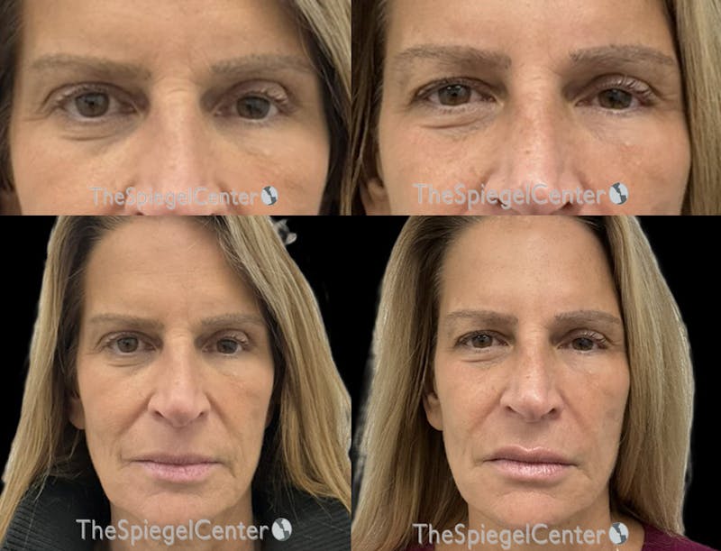 Temple Filler Before & After Gallery - Patient 235020 - Image 1