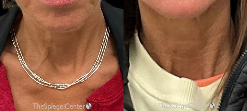 Neck Botox Before & After Gallery - Patient 408115 - Image 1