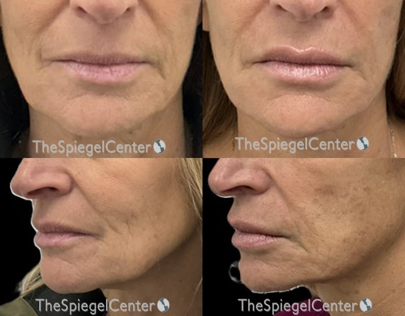 Nasolabial Fold Filler Before & After Gallery - Patient 256272 - Image 1