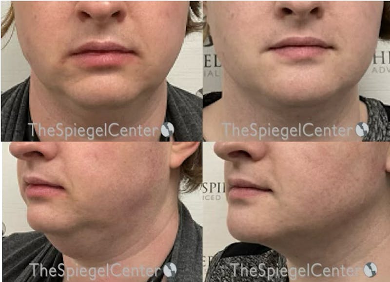 Chin Augmentation Before & After Gallery - Patient 273244 - Image 1