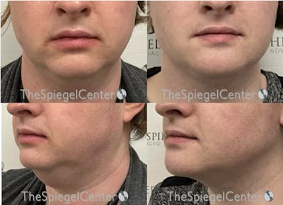 Chin Augmentation Before & After Gallery - Patient 273244 - Image 1