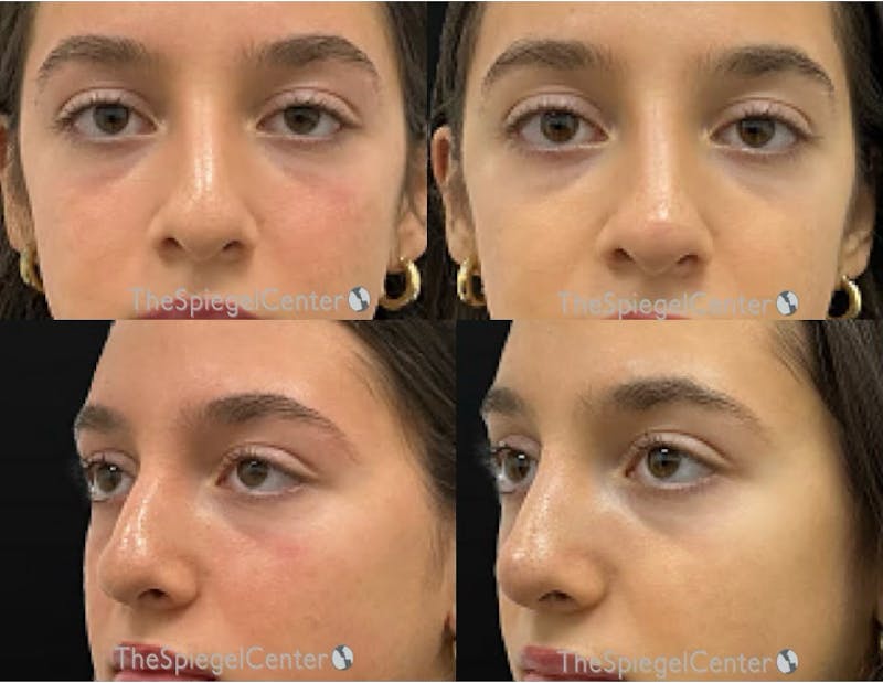 Non-Surgical Rhinoplasty / Nose Filler Before & After Gallery - Patient 197463 - Image 1