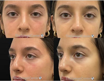 Non-Surgical Rhinoplasty / Nose Filler Before & After Gallery - Patient 197463 - Image 1