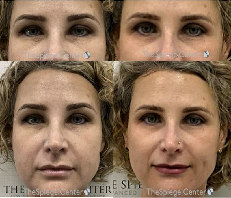 Temple Filler Before & After Gallery - Patient 121003 - Image 1