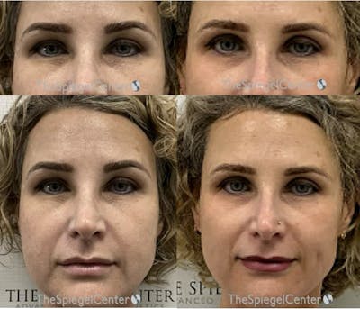 Temple Filler Before & After Gallery - Patient 121003 - Image 1