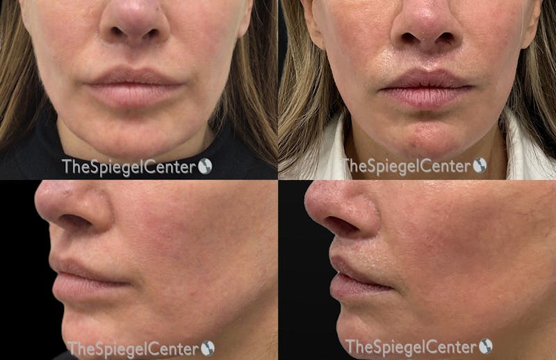 Lip Lift Before & After Gallery - Patient 392906 - Image 1