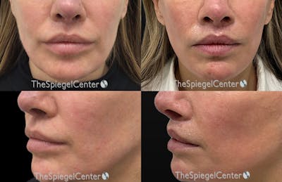 Lip Lift Before & After Gallery - Patient 392906 - Image 1