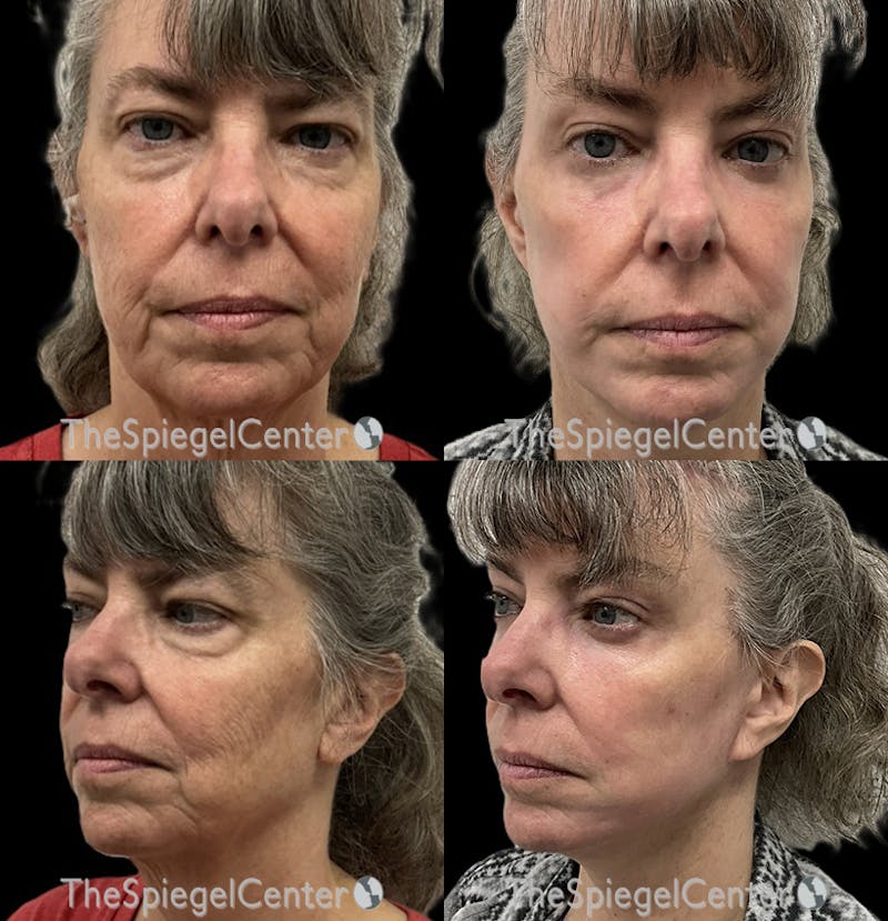 Facelift Before & After Gallery - Patient 205379 - Image 1