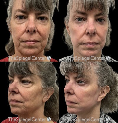 Facelift Before & After Gallery - Patient 205379 - Image 1