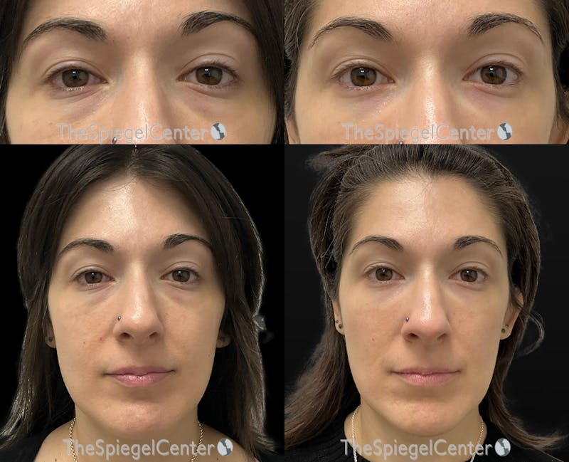 Temple Filler Before & After Gallery - Patient 454588 - Image 1