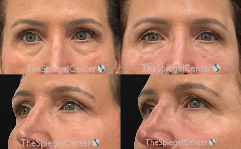 Tear Trough / Under Eye Fillers Before & After Gallery - Patient 328734 - Image 1