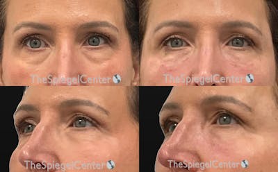 Tear Trough / Under Eye Fillers Before & After Gallery - Patient 328734 - Image 1