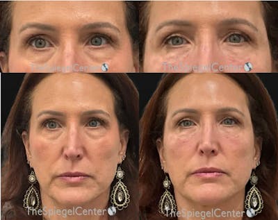 Temple Filler Before & After Gallery - Patient 779911 - Image 1